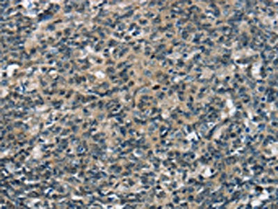 The image on the left is immunohistochemistry of paraffin-embedded Human tonsil tissue using SEPN1 Antibody(SEPN1 Antibody) at dilution 1/20, on the right is treated with synthetic peptide. (Original magnification: ×200)Rabbit anti-Human SEPN1 Polyclonal Antibody
