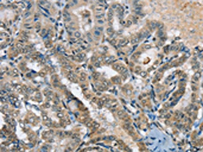 The image on the left is immunohistochemistry of paraffin-embedded Human thyroid cancer tissue using the antibody Antibody) at dilution 1/20, on the right is treated with synthetic peptide. (Original magnification: ×200)Rabbit anti-Human SEPN1 Polyclonal Antibody
