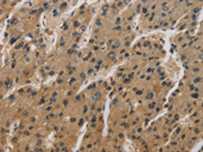 The image is immunohistochemistry of paraffin-embedded Human liver cancer tissue using CORO1C Antibody(CORO1C Antibody) at dilution 1/50. (Original magnification: ×200)Rabbit anti-Human CORO1C Polyclonal Antibody