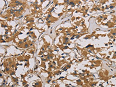The image is immunohistochemistry of paraffin-embedded Human thyroid cancer tissue using the antibody Antibody) at dilution 1/50. (Original magnification: ×200)Rabbit anti-Human CORO1C Polyclonal Antibody
