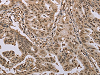 The image on the left is immunohistochemistry of paraffin-embedded Human gastric cancer tissue using CAB39 Antibody(CAB39 Antibody) at dilution 1/50, on the right is treated with synthetic peptide. (Original magnification: ×200)