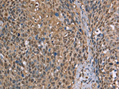 The image on the left is immunohistochemistry of paraffin-embedded Human cervical cancer tissue using the antibody Antibody) at dilution 1/50, on the right is treated with synthetic peptide. (Original magnification: ×200)
