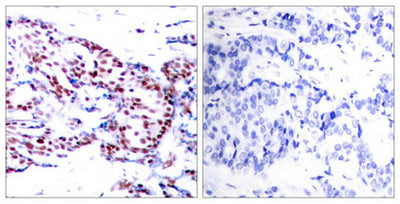 Immunohistochemical analysis of paraffin-embedded human breast carcinoma tissue using ATF2(Ab-71 or 53) Antibody(left) or the same antibody preincubated with blocking peptide(right).Rabbit anti-Human ATF2 Polyclonal Antibody