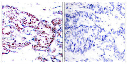 Immunohistochemical analysis of paraffin-embedded human breast carcinoma tissue using ATF2(Ab-71 or 53) Antibody(left) or the same antibody preincubated with blocking peptide(right).Rabbit anti-Human ATF2 Polyclonal Antibody
