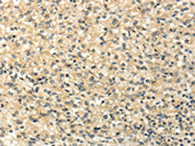 The image on the left is immunohistochemistry of paraffin-embedded Human prostate cancer tissue using CAMK1G Antibody(CAMK1G Antibody) at dilution 1/20, on the right is treated with fusion protein. (Original magnification: ×200)