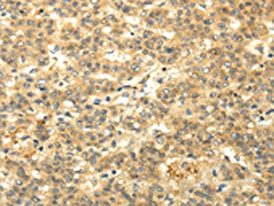 The image on the left is immunohistochemistry of paraffin-embedded Human liver cancer tissue using the antibody Antibody) at dilution 1/20, on the right is treated with fusion protein. (Original magnification: ×200)