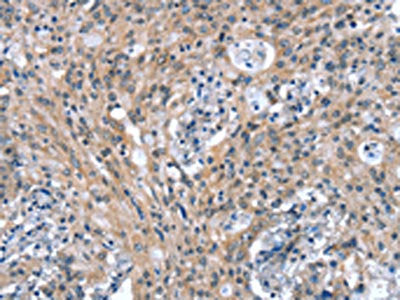 The image on the left is immunohistochemistry of paraffin-embedded Human thyroid cancer tissue using CTBP1 Antibody(CTBP1 Antibody) at dilution 1/25, on the right is treated with synthetic peptide. (Original magnification: ×200)Rabbit anti-Human CTBP1 Polyclonal Antibody