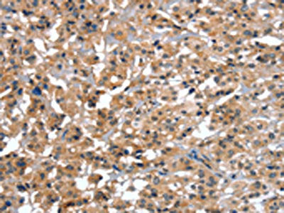 The image on the left is immunohistochemistry of paraffin-embedded Human gastic cancer tissue using the antibody Antibody) at dilution 1/25, on the right is treated with synthetic peptide. (Original magnification: ×200)Rabbit anti-Human CTBP1 Polyclonal Antibody