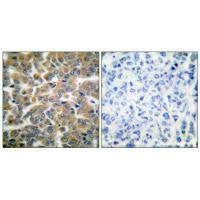Immunohistochemical analysis of paraffin-embedded human breast carcinoma tissue using GR (Ab-211) antibody.Rabbit anti-Human NR3C1 Polyclonal Antibody