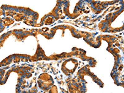The image on the left is immunohistochemistry of paraffin-embedded Human thyroid cancer tissue using SPARC Antibody(SPARC Antibody) at dilution 1/25, on the right is treated with fusion protein. (Original magnification: ×200)Rabbit anti-Human SPARC Polyclonal Antibody