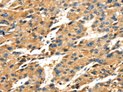 The image on the left is immunohistochemistry of paraffin-embedded Human liver cancer tissue using the antibody Antibody) at dilution 1/25, on the right is treated with fusion protein. (Original magnification: ×200)Rabbit anti-Human SPARC Polyclonal Antibody