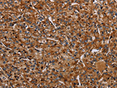 The image on the left is immunohistochemistry of paraffin-embedded Human prostate cancer tissue using the antibody Antibody) at dilution 1/40, on the right is treated with synthetic peptide. (Original magnification: ×200)Rabbit anti-Human NDUFA8 Polyclonal Antibody