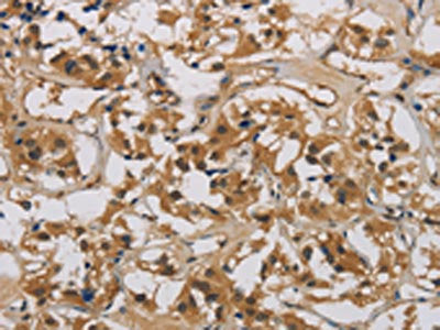 The image is immunohistochemistry of paraffin-embedded Human thyroid cancer tissue using CASP9 Antibody(CASP9 Antibody) at dilution 1/70. (Original magnification: ×200)