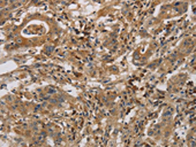 The image is immunohistochemistry of paraffin-embedded Human gastric cancer tissue using the antibody Antibody) at dilution 1/70. (Original magnification: ×200)