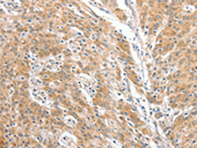 The image on the left is immunohistochemistry of paraffin-embedded Human gastric cancer tissue using COL4A3BP Antibody(COL4A3BP Antibody) at dilution 1/60, on the right is treated with fusion protein. (Original magnification: ×200)Rabbit anti-Human COL4A3BP Polyclonal Antibody