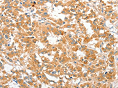 The image on the left is immunohistochemistry of paraffin-embedded Human thyroid cancer tissue using the antibody Antibody) at dilution 1/60, on the right is treated with fusion protein. (Original magnification: ×200)Rabbit anti-Human COL4A3BP Polyclonal Antibody