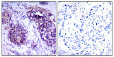 Immunohistochemical analysis of paraffin-embedded human breast carcinoma tissue using BCL-XL (phospho-Ser62) antibody.