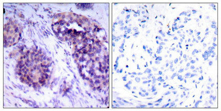 Immunohistochemical analysis of paraffin-embedded human breast carcinoma tissue using BCL-XL (phospho-Ser62) antibody.