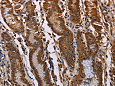 The image on the left is immunohistochemistry of paraffin-embedded Human gastric cancer tissue using KIF2A Antibody(KIF2A Antibody) at dilution 1/70, on the right is treated with fusion protein. (Original magnification: ×200)
