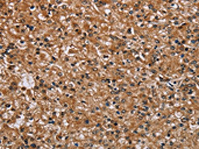 The image on the left is immunohistochemistry of paraffin-embedded Human prostate cancer tissue using PMS2 Antibody(PMS2 Antibody) at dilution 1/30, on the right is treated with synthetic peptide. (Original magnification: ×200)Rabbit anti-Human PMS2 Polyclonal Antibody