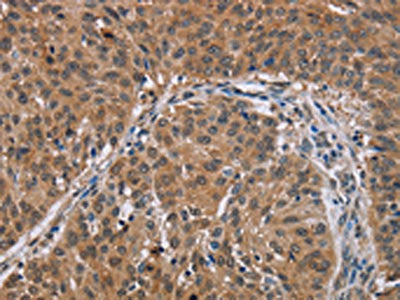 The image on the left is immunohistochemistry of paraffin-embedded Human lung cancer tissue using the antibody Antibody) at dilution 1/30, on the right is treated with synthetic peptide. (Original magnification: ×200)Rabbit anti-Human PMS2 Polyclonal Antibody