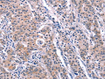 The image on the left is immunohistochemistry of paraffin-embedded Human gastric cancer tissue using ARC Antibody(ARC Antibody) at dilution 1/25, on the right is treated with fusion protein. (Original magnification: ×200)Rabbit anti-Human ARC Polyclonal Antibody