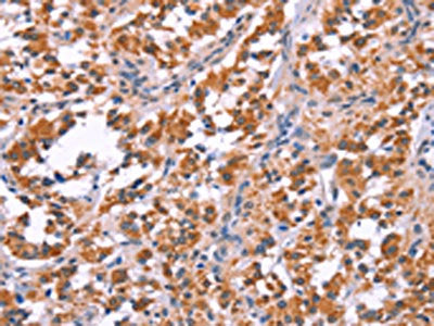 The image on the left is immunohistochemistry of paraffin-embedded Human thyroid cancer tissue using the antibody Antibody) at dilution 1/25, on the right is treated with fusion protein. (Original magnification: ×200)Rabbit anti-Human ARC Polyclonal Antibody