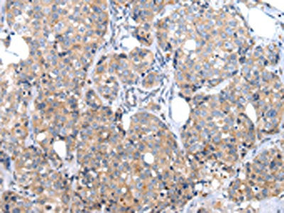 The image on the left is immunohistochemistry of paraffin-embedded Human breast cancer tissue using XKRX Antibody(XKRX Antibody) at dilution 1/30, on the right is treated with synthetic peptide. (Original magnification: ×200)Rabbit anti-Human XKRX Polyclonal Antibody
