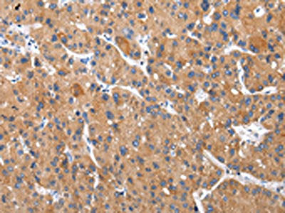 The image on the left is immunohistochemistry of paraffin-embedded Human liver cancer tissue using the antibody Antibody) at dilution 1/30, on the right is treated with synthetic peptide. (Original magnification: ×200)Rabbit anti-Human XKRX Polyclonal Antibody