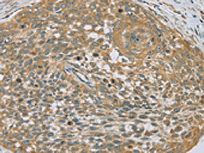 The image on the left is immunohistochemistry of paraffin-embedded Human cervical cancer tissue using EHHADH Antibody(EHHADH Antibody) at dilution 1/20, on the right is treated with fusion protein. (Original magnification: ×200)Rabbit anti-Human EHHADH Polyclonal Antibody