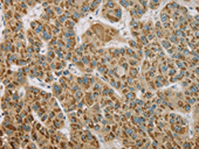 The image on the left is immunohistochemistry of paraffin-embedded Human liver cancer tissue using the antibody Antibody) at dilution 1/20, on the right is treated with fusion protein. (Original magnification: ×200)Rabbit anti-Human EHHADH Polyclonal Antibody
