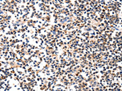 The image on the left is immunohistochemistry of paraffin-embedded Human tonsil tissue using AFP Antibody(AFP Antibody) at dilution 1/60, on the right is treated with fusion protein. (Original magnification: ×200)Rabbit anti-Human AFP Polyclonal Antibody
