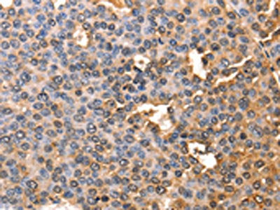 The image on the left is immunohistochemistry of paraffin-embedded Human liver cancer tissue using the antibody Antibody) at dilution 1/60, on the right is treated with fusion protein. (Original magnification: ×200)