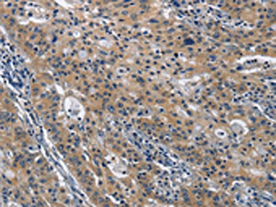 The image on the left is immunohistochemistry of paraffin-embedded Human gastric cancer tissue using CD160 Antibody(CD160 Antibody) at dilution 1/30, on the right is treated with fusion protein. (Original magnification: ×200)Rabbit anti-Human CD160 Polyclonal Antibody