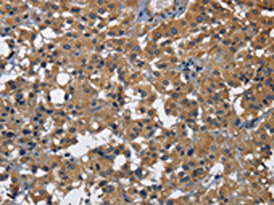 The image on the left is immunohistochemistry of paraffin-embedded Human thyroid cancer tissue using the antibody Antibody) at dilution 1/30, on the right is treated with fusion protein. (Original magnification: ×200)Rabbit anti-Human CD160 Polyclonal Antibody