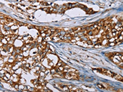 The image on the left is immunohistochemistry of paraffin-embedded Human breast cancer tissue using the antibody Antibody) at dilution 1/50, on the right is treated with synthetic peptide. (Original magnification: ×200)
