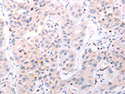 The image on the left is immunohistochemistry of paraffin-embedded Human lung cancer tissue using ACOT2 Antibody(ACOT2 Antibody) at dilution 1/25, on the right is treated with fusion protein. (Original magnification: ×200)