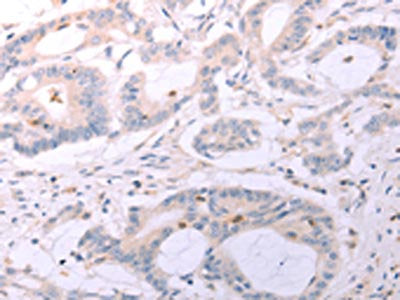 The image on the left is immunohistochemistry of paraffin-embedded Human colon cancer tissue using the antibody Antibody) at dilution 1/25, on the right is treated with fusion protein. (Original magnification: ×200)