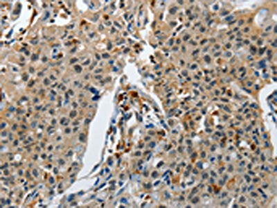 The image on the left is immunohistochemistry of paraffin-embedded Human lung cancer tissue using KDM1A Antibody(KDM1A Antibody) at dilution 1/60, on the right is treated with synthetic peptide. (Original magnification: ×200)