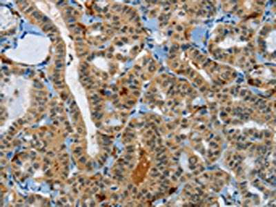 The image on the left is immunohistochemistry of paraffin-embedded Human thyroid cancer tissue using the antibody Antibody) at dilution 1/60, on the right is treated with synthetic peptide. (Original magnification: ×200)