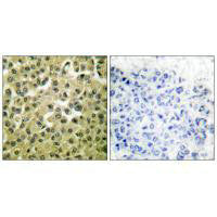 Immunohistochemical analysis of paraffin-embedded human breast carcinoma tissue using MCL1 antibody.