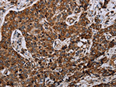 The image on the left is immunohistochemistry of paraffin-embedded Human liver cancer tissue using NDUFA4 Antibody(NDUFA4 Antibody) at dilution 1/40, on the right is treated with synthetic peptide. (Original magnification: ×200)Rabbit anti-Human NDUFA4 Polyclonal Antibody