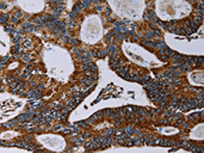 The image on the left is immunohistochemistry of paraffin-embedded Human colon cancer tissue using the antibody Antibody) at dilution 1/40, on the right is treated with synthetic peptide. (Original magnification: ×200)Rabbit anti-Human NDUFA4 Polyclonal Antibody