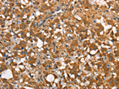 The image on the left is immunohistochemistry of paraffin-embedded Human thyroid cancer tissue using the antibody Antibody) at dilution 1/40, on the right is treated with synthetic peptide. (Original magnification: ×200)