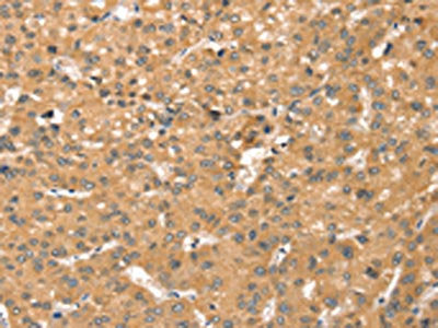 The image on the left is immunohistochemistry of paraffin-embedded Human liver cancer tissue using SMC6 Antibody(SMC6 Antibody) at dilution 1/20, on the right is treated with synthetic peptide. (Original magnification: ×200)Rabbit anti-Human SMC6 Polyclonal Antibody