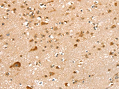 The image on the left is immunohistochemistry of paraffin-embedded Human brain tissue using the antibody Antibody) at dilution 1/20, on the right is treated with synthetic peptide. (Original magnification: ×200)Rabbit anti-Human SMC6 Polyclonal Antibody