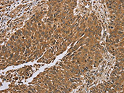 The image on the left is immunohistochemistry of paraffin-embedded Human lung cancer tissue using RAB8A Antibody(RAB8A Antibody) at dilution 1/45, on the right is treated with synthetic peptide. (Original magnification: ×200)Rabbit anti-Human RAB8A Polyclonal Antibody