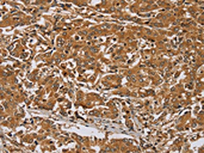 The image on the left is immunohistochemistry of paraffin-embedded Human liver cancer tissue using the antibody Antibody) at dilution 1/45, on the right is treated with synthetic peptide. (Original magnification: ×200)Rabbit anti-Human RAB8A Polyclonal Antibody
