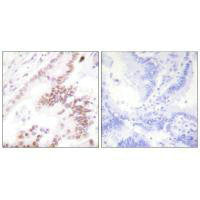 Immunohistochemistry analysis of paraffin-embedded human lung carcinoma tissue using p300 antibody.Rabbit anti-Human EP300 Polyclonal Antibody