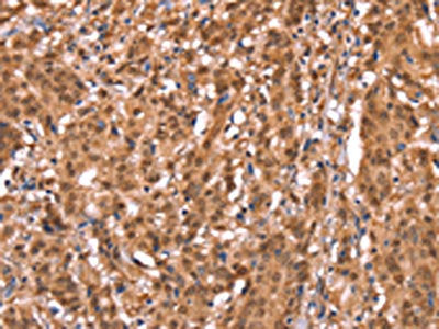 The image on the left is immunohistochemistry of paraffin-embedded Human gastric cancer tissue using FXR1 Antibody(FXR1 Antibody) at dilution 1/20, on the right is treated with synthetic peptide. (Original magnification: ×200)Rabbit anti-Human FXR1 Polyclonal Antibody